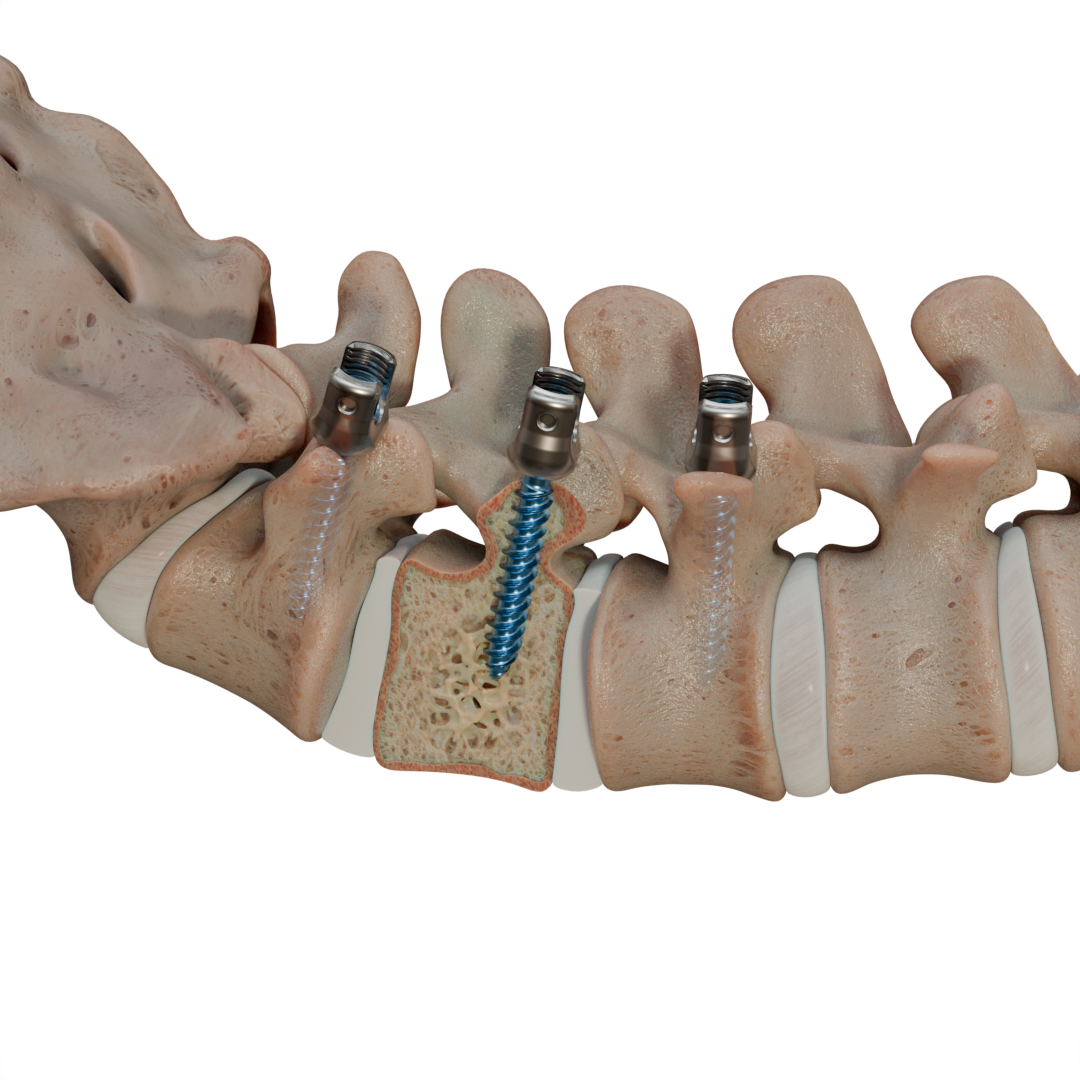 Lumbar Fusion Procedure